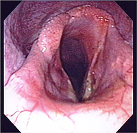 Upper Airway